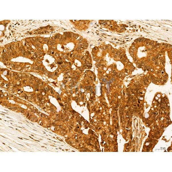 ADRM1 Antibody - DF12142 at 1/100 staining Human colorectal cancer by IHC-P.