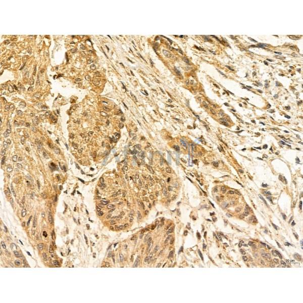ADRM1 Antibody - DF12142 at 1/100 staining Human esophageal cancer by IHC-P.