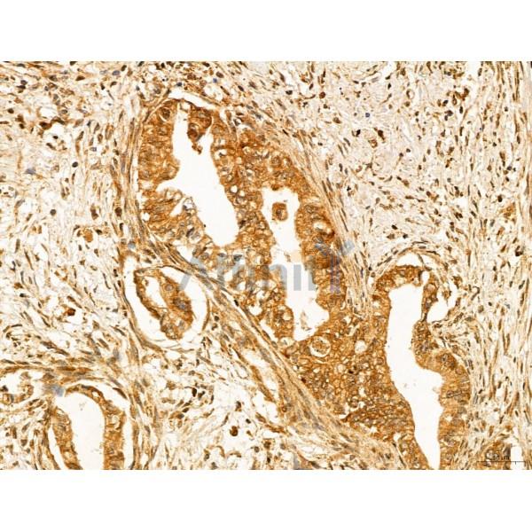 ADRM1 Antibody - DF12142 at 1/100 staining Human pancreatic cancer by IHC-P.