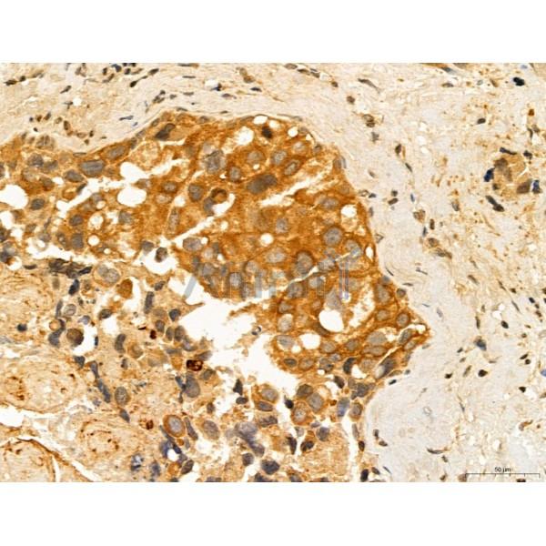 ADRM1 Antibody - DF12142 at 1/100 staining Human mammary cancer by IHC-P.