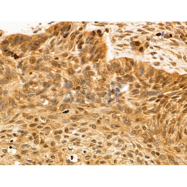 ADRM1 Antibody - DF12142 at 1/100 staining Human lung cancer by IHC-P.