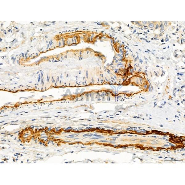 CAPZA1 Antibody - DF12145 at 1/100 staining Human mammary cancer by IHC-P.