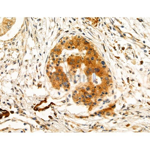 CAPZA1 Antibody - DF12145 at 1/100 staining Human pancreatic cancer by IHC-P.