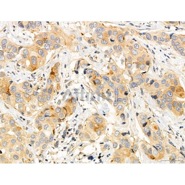 CAPZA1 Antibody - DF12145 at 1/100 staining Human mammary cancer by IHC-P.