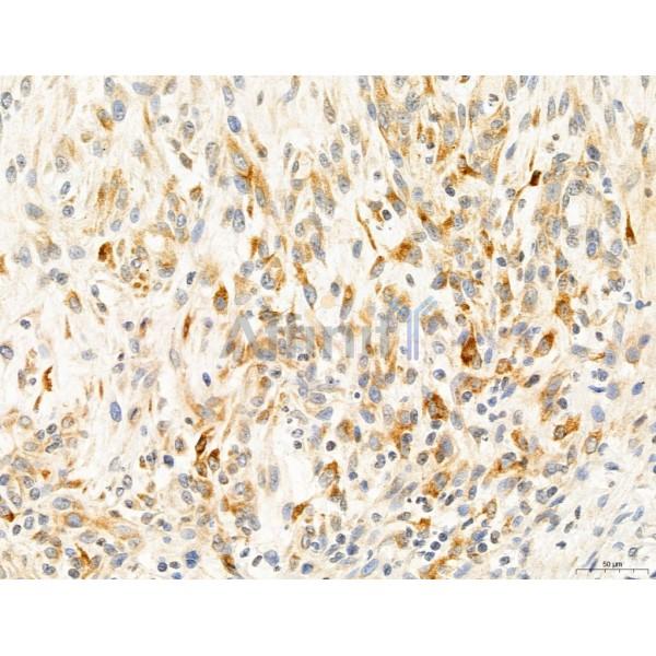 CAPZA1 Antibody - DF12145 at 1/100 staining Human lung cancer by IHC-P.