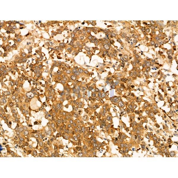 CCP1 Antibody - DF12146 at 1/100 staining Human gastric cancer by IHC-P.