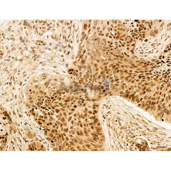 CCP1 Antibody - DF12146 at 1/100 staining Human lung cancer by IHC-P.
