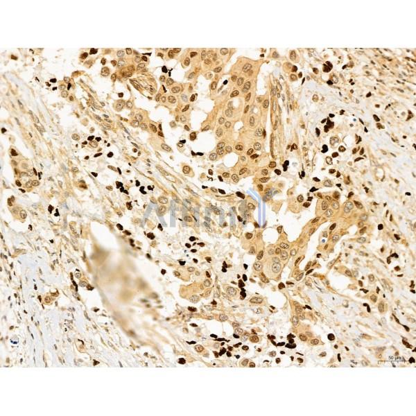 CCP1 Antibody - DF12146 at 1/100 staining Human mammary cancer by IHC-P.