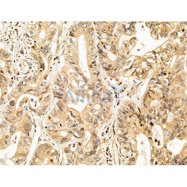 CCP1 Antibody - DF12146 at 1/100 staining Human colorectal cancer by IHC-P.
