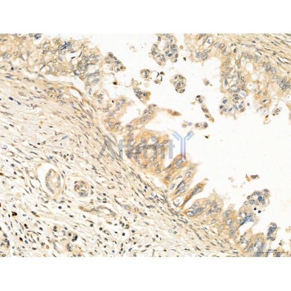 CCP1 Antibody - DF12146 at 1/100 staining Human pancreatic cancer by IHC-P.