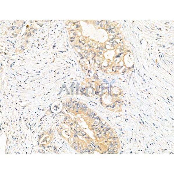 CHMP2A Antibody - DF12147 at 1/100 staining Human colorectal cancer by IHC-P.