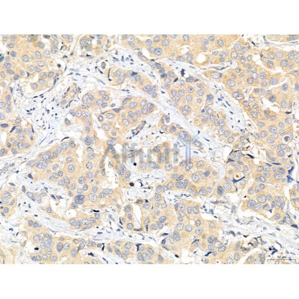 CHMP2A Antibody - DF12147 at 1/100 staining Human mammary cancer by IHC-P.