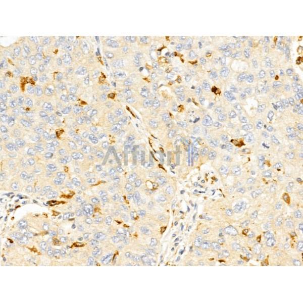 RNH1 Antibody - DF12170 at 1/100 staining Human lung cancer by IHC-P.