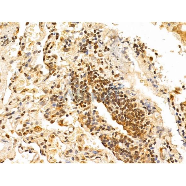 TAF12 Antibody - DF12175 at 1/100 staining Human lung cancer by IHC-P.