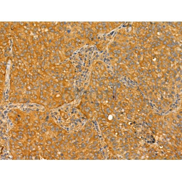 TTLL6 Antibody - DF12178 at 1/100 staining Human lung cancer by IHC-P.
