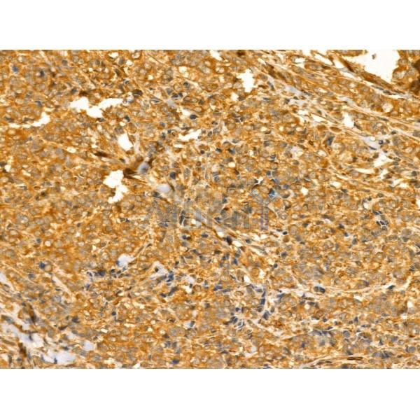 TTLL6 Antibody - DF12178 at 1/100 staining Human mammary cancer by IHC-P.