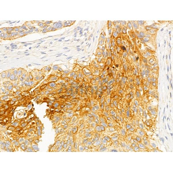 DNAJB14 Antibody - DF12198 at 1/100 staining Human lung cancer by IHC-P.