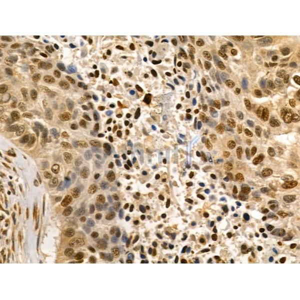 LARP7 Antibody - DF12208 at 1/100 staining Human lung cancer by IHC-P.