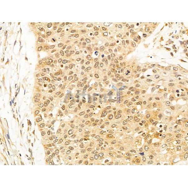 OIP5 Antibody - DF12217 at 1/100 staining Human esophageal cancer by IHC-P.