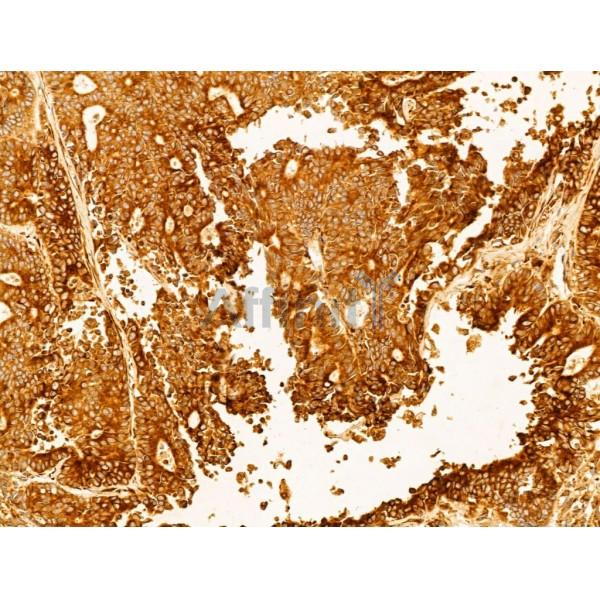 P4HA1 Antibody - DF12219 at 1/100 staining Human colorectal cancer by IHC-P.