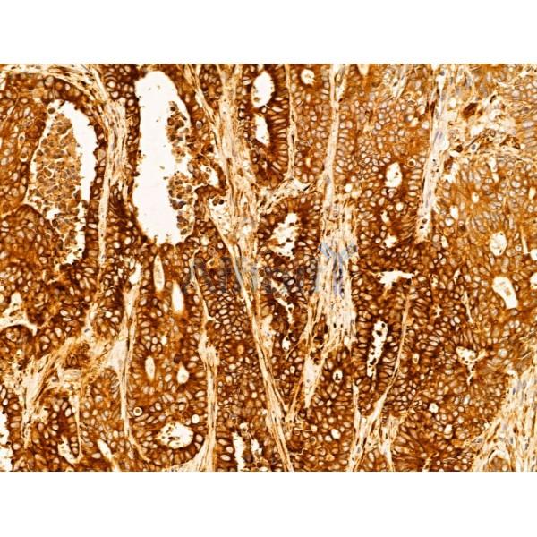 P4HA1 Antibody - DF12219 at 1/100 staining Human colorectal cancer by IHC-P.