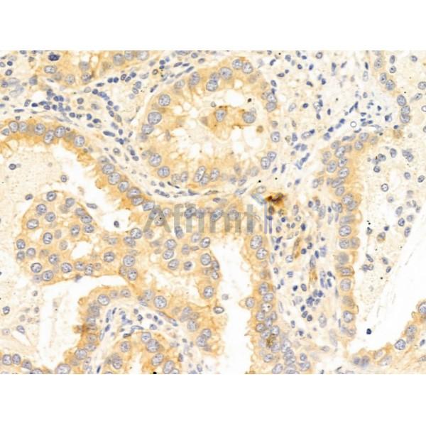 WWP1 Antibody - DF12506 at 1/100 staining Human lung cancer by IHC-P.