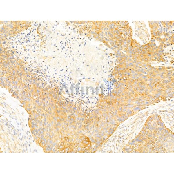 FAM92A1 Antibody - DF13000 at 1/100 staining Human lung cancer by IHC-P.