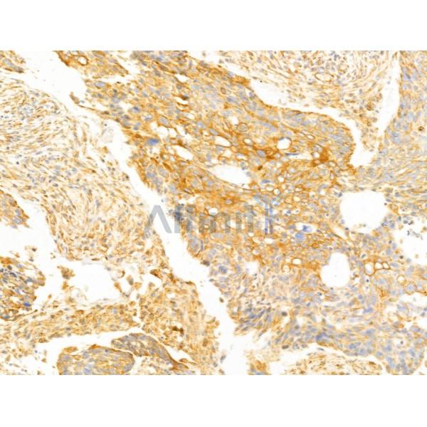 FAM92A1 Antibody - DF13000 at 1/100 staining Human lung cancer by IHC-P.
