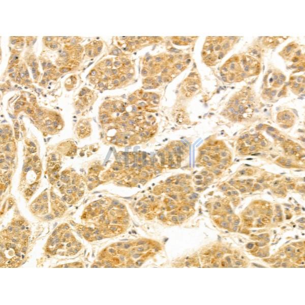 FUT6 Antibody - DF13025 at 1/100 staining Human liver cancer by IHC-P.