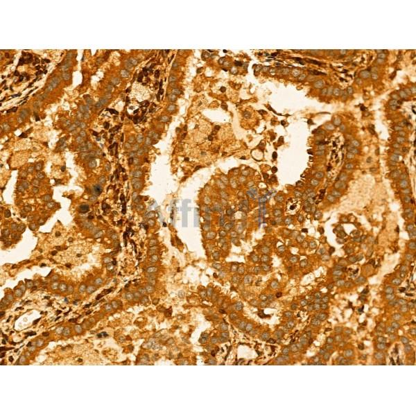 GLTP Antibody - DF13042 at 1/100 staining Human lung cancer by IHC-P.