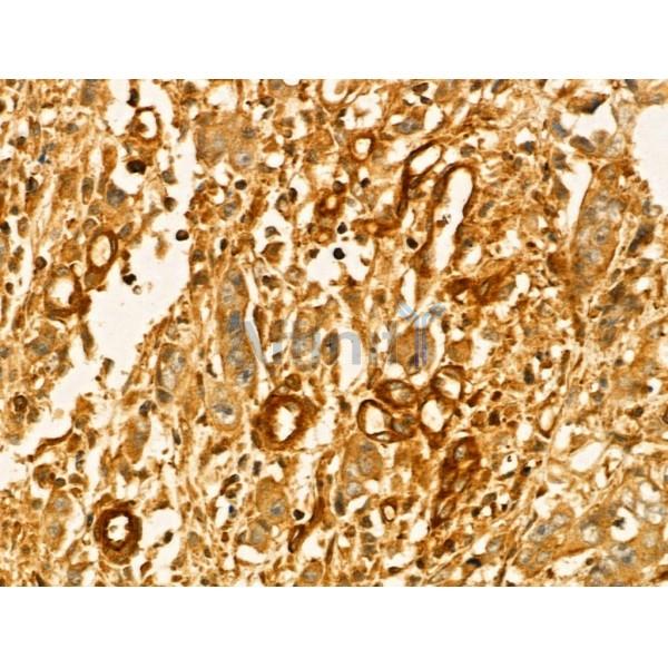 GLTP Antibody - DF13042 at 1/100 staining Human gastric cancer by IHC-P.