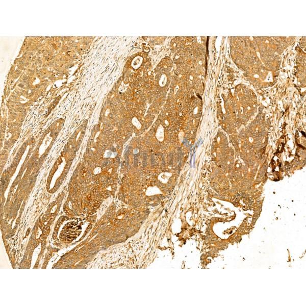 GPX8 Antibody - DF13052 at 1/100 staining Human colorectal cancer by IHC-P.