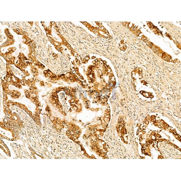 GPX8 Antibody - DF13052 at 1/100 staining Human pancreatic cancer by IHC-P.