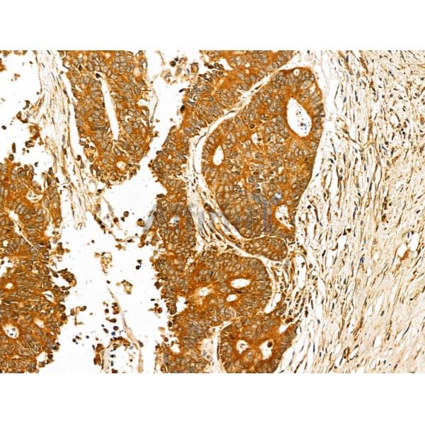 Harmonin Antibody - DF13054 at 1/100 staining Human colorectal cancer by IHC-P.