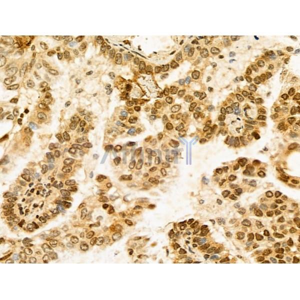 HIST1H1T Antibody - DF13061 at 1/100 staining Human lung cancer by IHC-P.