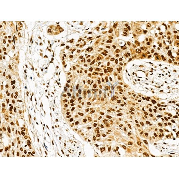 HNRNPH3 Antibody - DF13064 at 1/100 staining Human esophageal cancer by IHC-P.