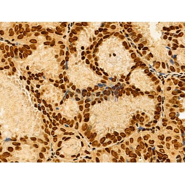 HNRNPH3 Antibody - DF13064 at 1/100 staining Human lung cancer by IHC-P.