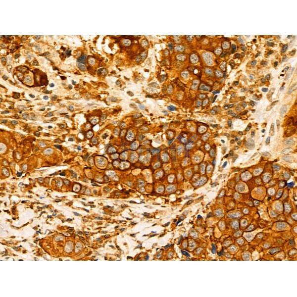 Kv1.4 Antibody - DF13119 at 1/100 staining Human mammary cancer by IHC-P.