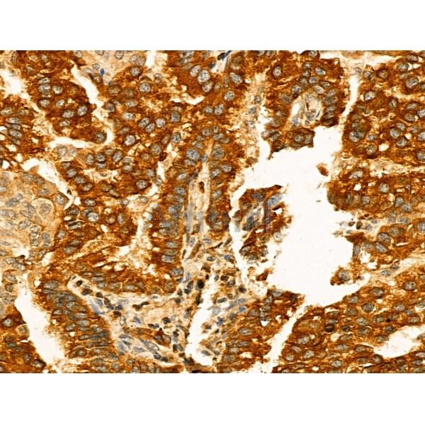 Kv1.4 Antibody - DF13119 at 1/100 staining Human lung cancer by IHC-P.