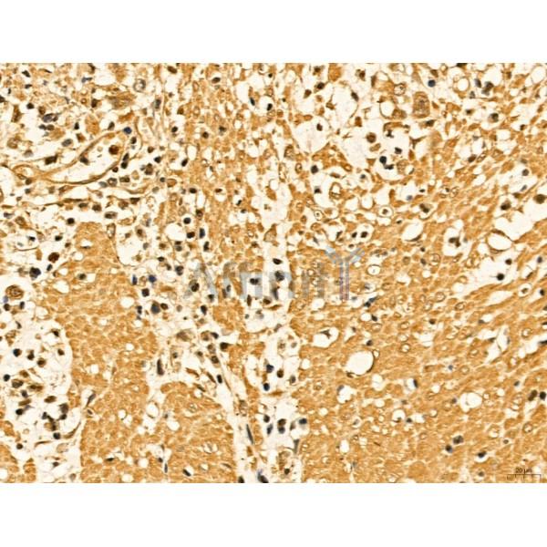 LAS1L Antibody - DF13123 at 1/100 staining Human gastric cancer by IHC-P.