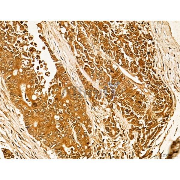 LAS1L Antibody - DF13123 at 1/100 staining Human colorectal cancer by IHC-P.