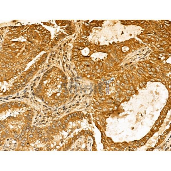 LAS1L Antibody - DF13123 at 1/100 staining Human lung cancer by IHC-P.