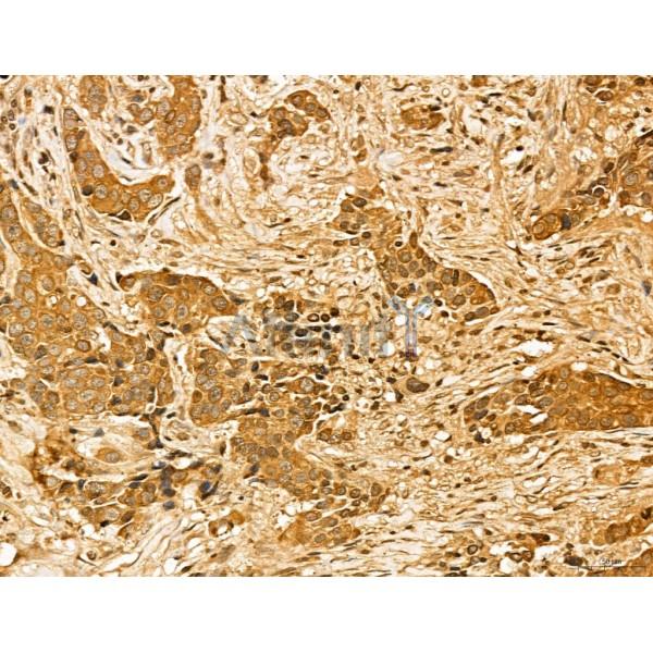 LAS1L Antibody - DF13123 at 1/100 staining Human mammary cancer by IHC-P.