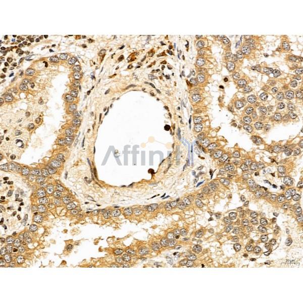 LETM2 Antibody - DF13128 at 1/100 staining Human lung cancer by IHC-P.