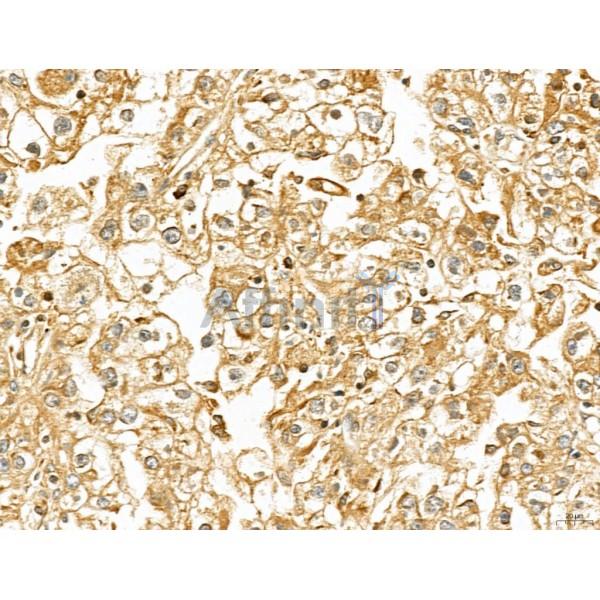 LETM2 Antibody - DF13128 at 1/100 staining Human liver cancer by IHC-P.