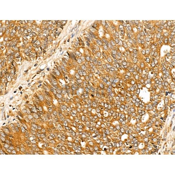 LETM2 Antibody - DF13128 at 1/100 staining Human colorectal cancer by IHC-P.