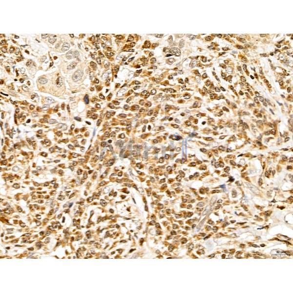 LETM2 Antibody - DF13128 at 1/100 staining Human mammary cancer by IHC-P.