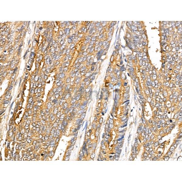LIN7C Antibody - DF13130 at 1/100 staining Human colorectal cancer by IHC-P.