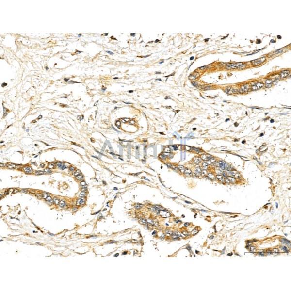 LIN7C Antibody - DF13130 at 1/100 staining Human pancreatic cancer by IHC-P.