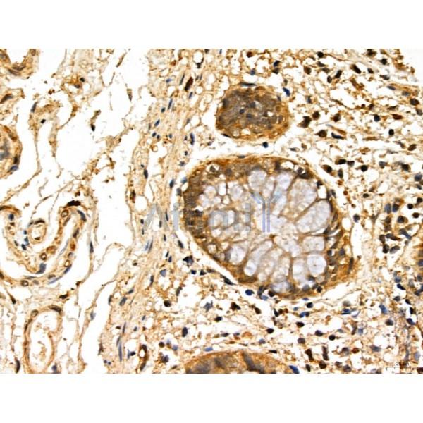 LOH12CR1 Antibody - DF13131 at 1/100 staining Human normal tissues adjacent to colorectal cancer by IHC-P.
